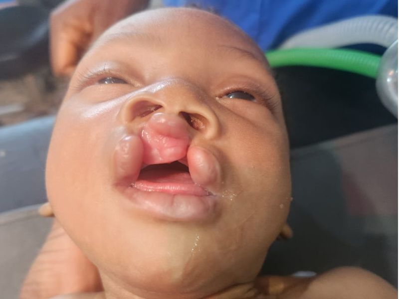 Child before cleft surgery